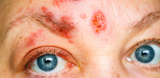 Herpes ocular y en cejas