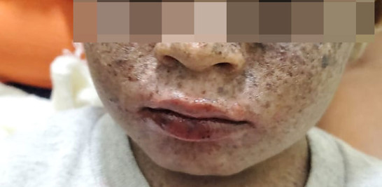 Un niño con xeroderma pigmentosa, una de las enfermedades raras de la piel que son tratadas en el instituto Dermatológico y Cirugía de Piel. EXTERNA /