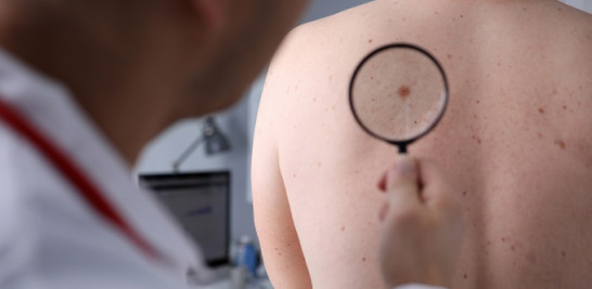 El melanoma puede suponer un serio peligro para la salud, ya que se trata de la forma más grave de cáncer de piel. Foto cedida
