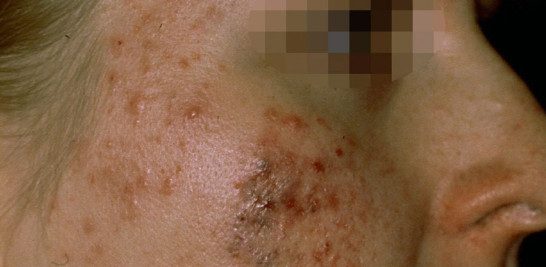 La lesión elemental del acné es el comedón, que consiste en un folículo dilatado y lleno de sebo. Foto cedida