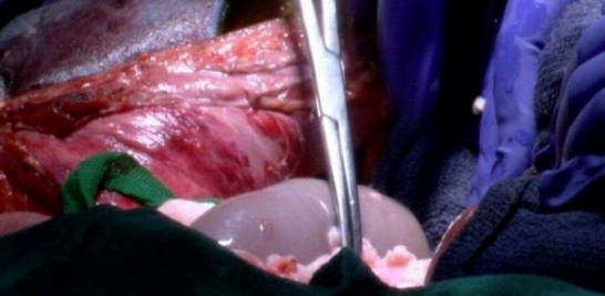El trasplante de riñón de un cerdo a un humano, en una imagen difundida el 19 de enero de 2022 Handout Universidad de Alabama/AFP