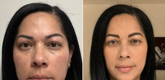 Karen Báez Noboa antes y después de la explantación. En la primera imagen, presenta el rostro inflamado.
