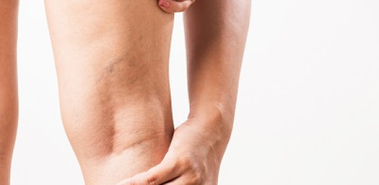 La hinchazón de piernas es bastante frecuente. Foto: TK Home Solutions/EFE.