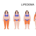 Lipedema: el cúmulo de grasa que se confunde con celulitis y que afecta a muchas mujeres