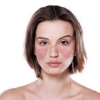 Factores genéticos, hormonales y ambientales pueden desarrollar lupus eritematoso sistémico