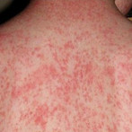 Más de 900 casos de sarampión y 10 estados con brotes activos en EE.UU.