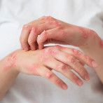 Dermatológico asiste actualmente a 205 pacientes por lepra