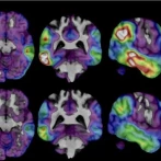 Investigadores buscan combatir el Alzheimer con fármaco experimental