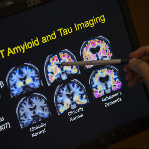 Un médico señala imágenes de un escáner cerebral dentro de un estudio sobre el Alzheimer en el hospital de la Universidad de Georgetown, el martes 19 de mayo de 2015 en Washington