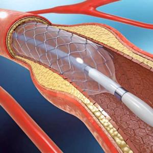 La angioplastia se diferencia del cateterismo, porque este último se hace con fines diagnósticos para determinar si hay obstrucciones.