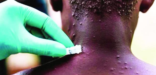 Todos los casos de viruela símica en el país han sido detectados en adultos.