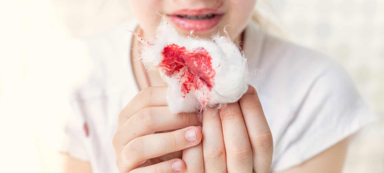 La hemofilia se presenta cuando la sangre no coagula como debería.