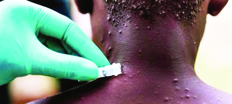 Todos los casos de viruela símica en el país han sido detectados en adultos.