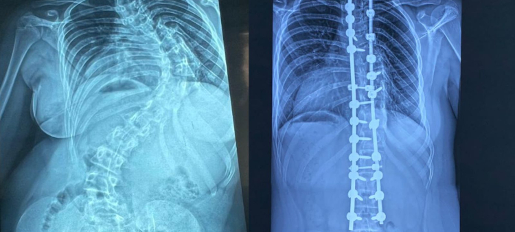 Más de 350 cirugías de corrección de deformidades de columna