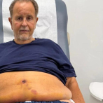 Raúl de Molina se sometió a una abdominoplastia por exceso de piel: 