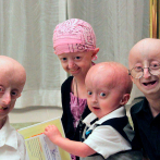 Progeria, tener un niño anciano