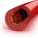 Detección tardía y mal control elevan cifras de colesterol en Latinoamérica
