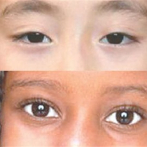 La genética hace que la prevalencia del lupus sea mayor en la población negra y asiática que en la blanca