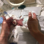 Un bebé prematuro, nacido con 268 gramos de peso, deja el hospital sano y salvo