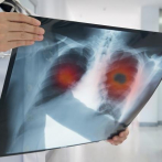 Sistema computacional ayudaría a detectar cáncer de pulmón