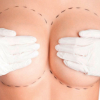 10 mitos y realidades sobre los implantes mamarios y la lactancia materna