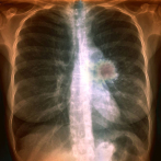 La supervivencia del cáncer de pulmón avanzado empieza a contarse en años