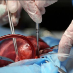 Cuba y Turquía atenderán a los pacientes venezolanos que esperan por trasplantes médicos