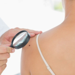 Haber sufrido cinco quemaduras en la piel durante la infancia aumenta el riesgo de sufrir cáncer