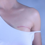 Cáncer de mama, el impacto emocional tras la mastectomía