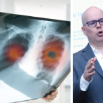 Cáncer de pulmón: Novedad para tratarlo