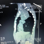 Joven con tumor en el pecho necesita 500 mil pesos para ser operado