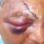 Anciano de 80 años es atacado con un martillo por hombre al que le dio bofetada hace 30 años