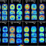 Investigan Detección precoz del Alzheimer mediante la medición de la glucosa en el cerebro por resonancia magnética