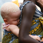La ONU alerta de que 53.000 menores albinos en Malaui pueden ser asesinados de camino a la escuela