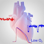 Los pacientes críticos con COVID-19 tienen 10 veces más probabilidades de desarrollar arritmias cardíacas