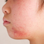 Dermatitis atópica se exacerba por medidas de higiene de covid-19, dicen expertos