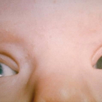 La cirugía de cataratas en la infancia aumenta el riesgo de glaucoma