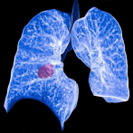Un hallazgo de investigadores americanos abre la puerta a un tratamiento para un tipo de cáncer de pulmón agresivo