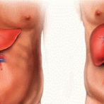 Disminuyen trasplantes de hígado en RD por falta de donación de órganos y cobertura médica