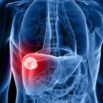 Un estudio revela qué pacientes de cáncer de hígado se benefician de la inmunoterapia