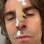 Liam Gallagher aparece herido en una foto tras 