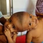Dos bebes siameses yemeníes separados con éxito tras compleja operación en Jordania