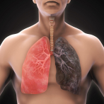 Las muertes globales por tuberculosis subieron por primera vez en una década