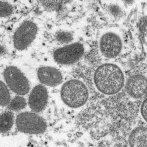 OMS: Viruela símica no será pandemia; aún hay incógnitas