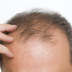 EEUU aprueba primera píldora para el tratamiento de la alopecia