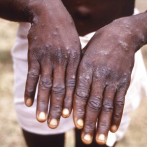 África dice tratar brote de viruela símica como emergencia
