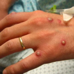Pacientes con viruela símica siguen estables