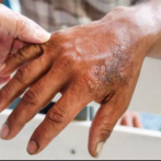 Enfermedades más comunes de la piel en el país