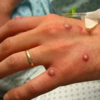 Se registran dos nuevos casos de viruela símica en Santiago y San Cristóbal