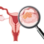 Extirpan un cáncer de ovario de 70 kilos a una mujer italiana
